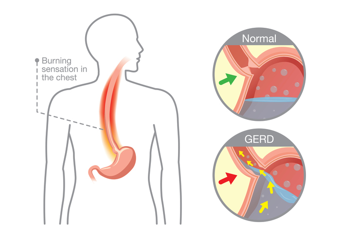 pin-on-hiatal-hernia